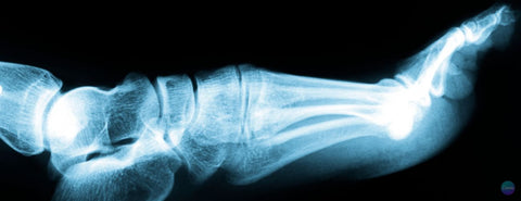 Rentgen zlomeniny nohy.
